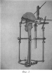 Способ лечения переломов проксимального отдела бедренной кости (патент 2477089)