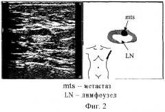 Способ ультразвуковой диагностики метастатического поражения регионарных лимфатических узлов (патент 2284754)