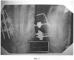 Способ фиксации коротких трубчатых костей кисти для лечения их переломов и деформаций (патент 2280415)