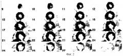 Способ диагностики жизнеспособности миокарда (патент 2266052)