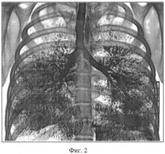 Способ диагностики гиперинфляции легких (патент 2544099)