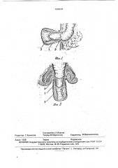 Способ хирургического лечения выпадения кишки из ануса (патент 1806639)