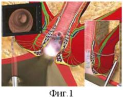 Способ модифицированного видеоассистированного лечения свищей прямой кишки (патент 2524305)