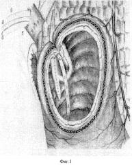 Способ хирургического лечения низкой околососочковой осложненной язвы двенадцатиперстной кишки с повреждением санториниева протока и стриктурой большого дуоденального сосочка (патент 2292847)