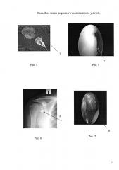 Способ лечения переднего вывиха плеча у детей (патент 2663076)