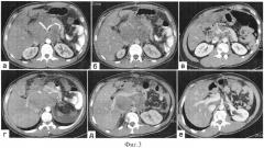 Способ двухфазного контрастирования при мультиспиральной компьютерной томографии органов брюшной полости и забрюшинного пространства в процессе динамического наблюдения онкологических больных (патент 2556619)