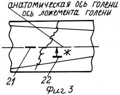 Способ (варианты) и шина для дистракционно-компрессионного лечения переломов длинных трубчатых костей нижних конечностей человека (патент 2304944)