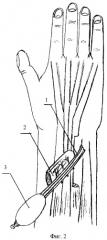 Способ пластики кисти тыльным островковым кожно-жировым лоскутом предплечья с ретроградным кровотоком (патент 2383307)