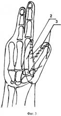 Способ перемещения культи пястной кости при последствиях глубокого ожога кисти (патент 2391930)