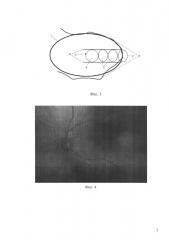 Способ определения локализации макулы при ретинопатии недоношенных (варианты) (патент 2645411)