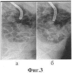 Способ лечения панкреатических затеков после трансплантации поджелудочной железы (патент 2549995)
