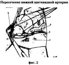 Способ экстрафасциального удаления доли щитовидной железы (патент 2357684)