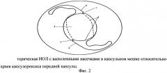 Способ повышения ротационной стабильности торических интраокулярных линз (патент 2535612)
