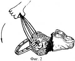 Способ репозиции переломов пяточной кости с большим смещением отломков (патент 2385683)