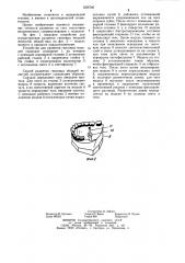 Способ разметки гипсовой модели челюсти (патент 1256740)