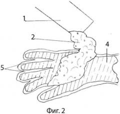 Способ лечения ожогов кисти и профилактики послеожоговых рубцовых деформаций и синдактилий (патент 2559731)