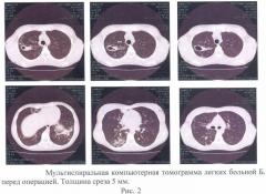 Способ лечения деструктивного туберкулеза легких (патент 2475192)