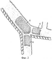 Способ хирургического лечения экспираторного стеноза трахеи и главных бронхов (патент 2376949)