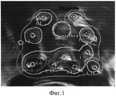 Способ планирования высокодозной внутритканевой лучевой терапии рака предстательной железы (патент 2576875)