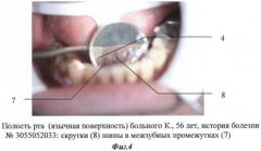 Способ шинирования зубов при пародонтите (патент 2436540)