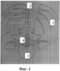 Способ реконструкции позвоночного канала при лечении стеноза пояснично-крестцового отдела позвоночника (патент 2531927)