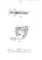 Электрохирургический инструмент (патент 1553089)