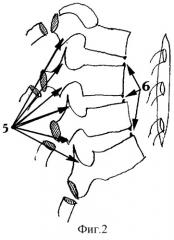 Способ мобилизации кифотического компонента при хирургической коррекции тяжелых кифосколиозов грудной локализации у детей (патент 2299699)