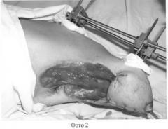 Способ профилактики и лечения приводящих контрактур, ран культи плеча и подмышечной области у обожженных (патент 2261676)