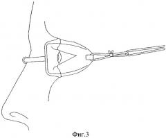 Малые интра-орбитальные очки для плавания (патент 2433850)