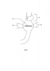 Способ восстановления непрерывности пищеварительного тракта после гастрэктомии (патент 2655980)