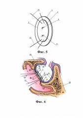 Способ пластики и герметизации дефекта твердой мозговой оболочки в области костного дефекта основания черепа (патент 2635633)