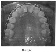 Способ ретенции результата ортодонтического лечения глубокого резцового перекрытия (патент 2495643)