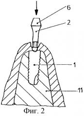 Зубной протез с опорой на имплантат и способ его изготовления (патент 2250088)