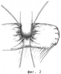Способ наложения антирефлюксного холедохоеюноанастомоза (патент 2470592)