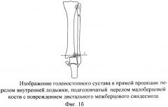 Способ оперативного лечения подголовчатых переломов малоберцовой кости при переломовывихах в голеностопном суставе (патент 2369341)