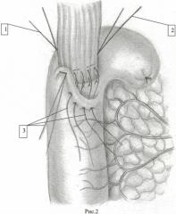 Способ замещения желудка после гастрэктомии (патент 2474392)