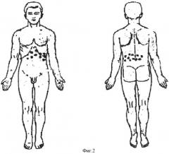 Способ дифференциальной диагностики формы острого панкреатита (патент 2339305)