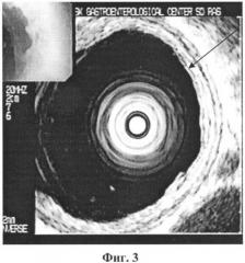 Способ диагностики пищевода баррета (патент 2343839)