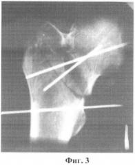 Способ диагностики степени ротационного смещения отломков проксимального отдела бедренной кости (патент 2462992)