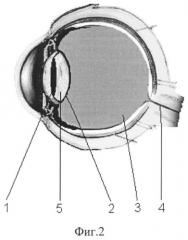 Способ улучшения зрения при факоэмульсификации (патент 2542965)