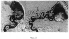 Способ эмболизации церебральных артериовенозных мальформаций (патент 2497457)