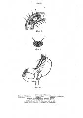 Способ лечения дуоденальной кровоточащей язвы (патент 1158171)