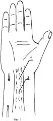 Способ хирургической профилактики образования рубцового блока сухожилий предплечья (патент 2445030)