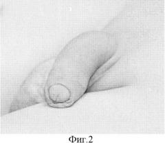 Способ интракавернозного протезирования полового члена (патент 2326602)