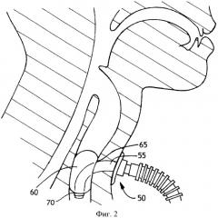 Улучшенная трахеостомическая трубка с баллонной манжетой (патент 2485981)