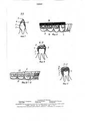 Протез для лечения патологической стираемости зубов (патент 1595500)