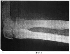 Способ остеосинтеза переломов локтевого отростка (патент 2409327)