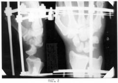 Способ лечения чрезладьевидно-перилунарного вывиха костей запястья (патент 2271163)
