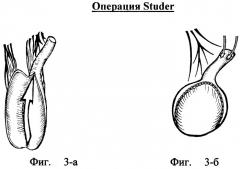 Способ инвертирующей ортотопической илеоцистопластики при короткой брыжейке подвздошной кишки (патент 2371102)