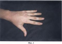Способ реабилитации разгибательных контрактур пальцев кисти (патент 2471467)